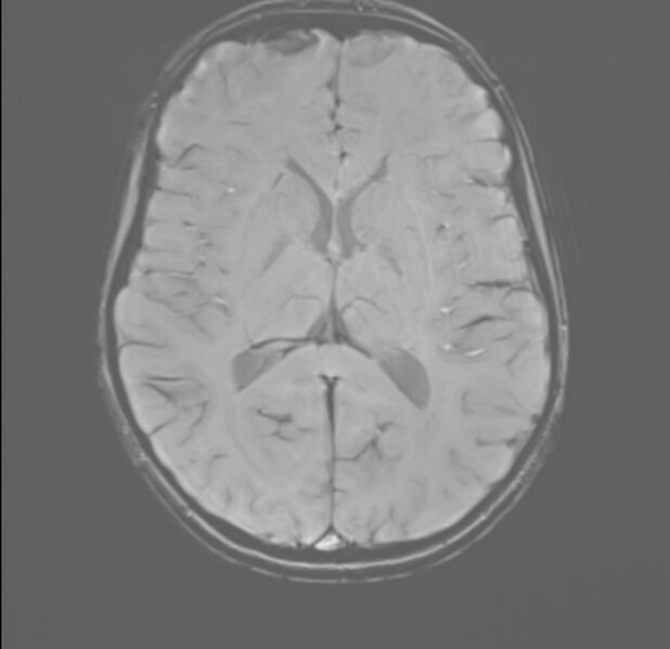 File:Brainstem glioma (Radiopaedia 70548-80674 Axial SWI 34).jpg