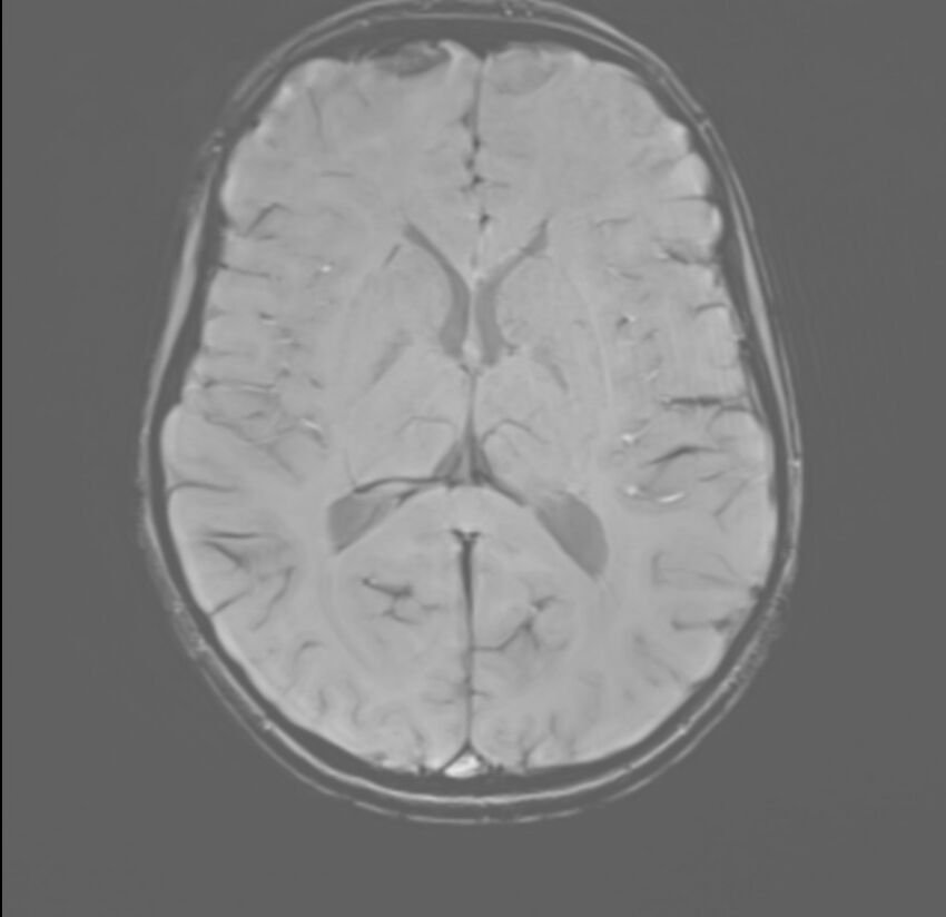 Brainstem glioma (Radiopaedia 70548-80674 Axial SWI 34).jpg