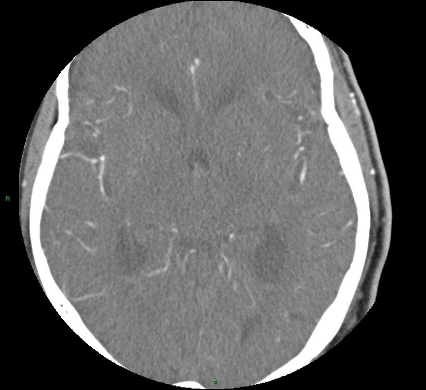 Brainstem hemorrhage (Radiopaedia 58794-66028 D 93).jpg