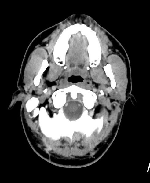File:Branchial cleft cyst (Radiopaedia 31167-31875 Axial C+ delayed 10).jpg