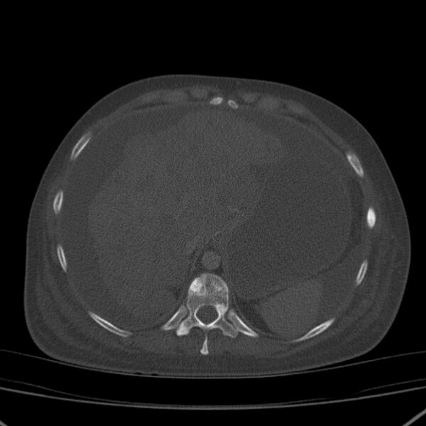 File:Breast cancer metastases - hepatic and skeletal (Radiopaedia 34201-35461 Axial bone window 38).jpg