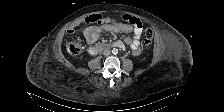 Breast cancer pelvic bony metastases (Radiopaedia 84470-99824 Axial bone window 7).jpg