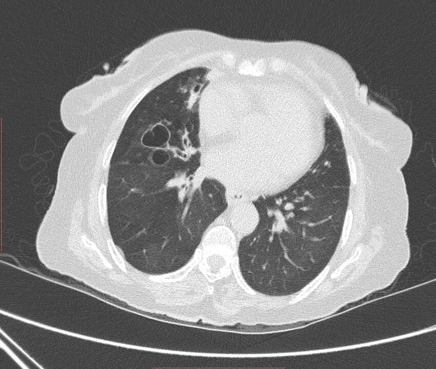 Bronchiectasis (Radiopaedia 72693-83293 Axial lung window 82).jpg