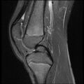 Bucket handle tear - lateral meniscus (Radiopaedia 72124-82634 Sagittal PD fat sat 9).jpg