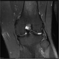 Bucket handle tear - lateral meniscus (Radiopaedia 7246-8187 Coronal T2 fat sat 8).jpg