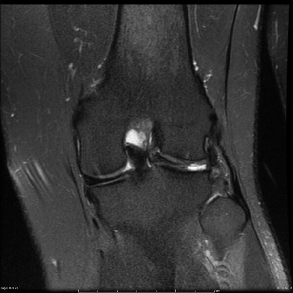 File:Bucket handle tear - lateral meniscus (Radiopaedia 7246-8187 Coronal T2 fat sat 8).jpg