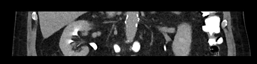 Buried bumper syndrome - gastrostomy tube (Radiopaedia 63843-72575 Coronal Inject 56).jpg