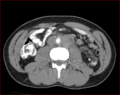 Burned-out testicular choriocarcinoma (Radiopaedia 32822-34040 B 13).PNG