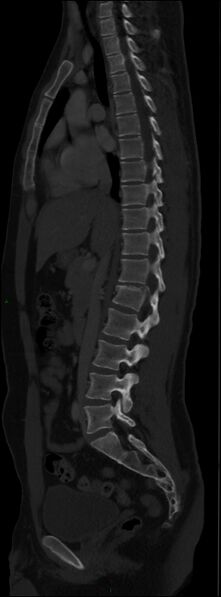 File:Burst fracture (Radiopaedia 83168-97542 Sagittal bone window 64).jpg