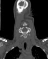 Butterfly vertebra (Radiopaedia 77903-90209 Coronal bone window 12).jpg