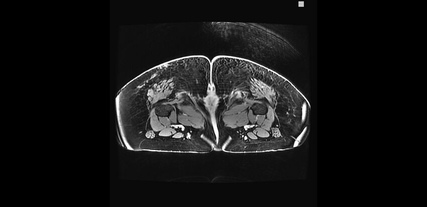 Buttock filler complications (Radiopaedia 63497-72115 Axial T1 C+ 57).jpg