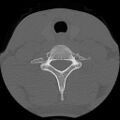 C5 facet fracture (Radiopaedia 58374-65499 Axial bone window 71).jpg