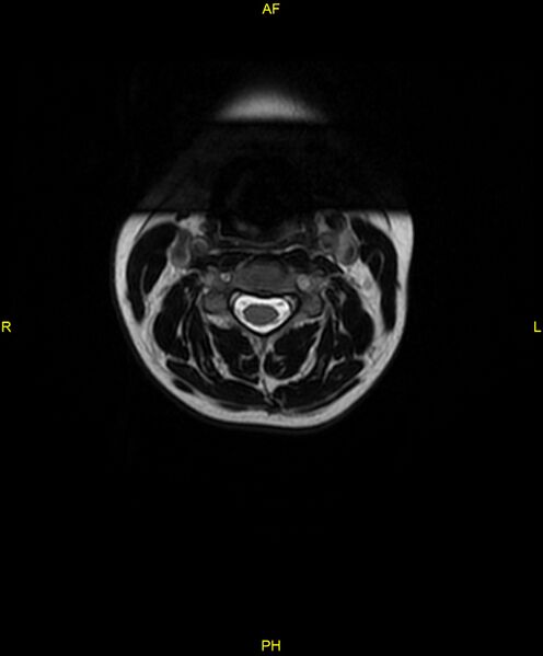File:C5 nerve sheath tumor (Radiopaedia 85777-101596 Axial T2 14).jpg