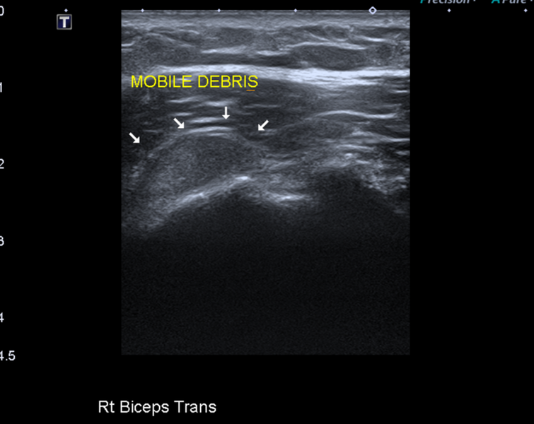 File:Calcific tendinitis (ruptured) (Radiopaedia 56393-63053 A 4).png