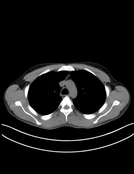 File:Calcifying pulmonary metastases (Radiopaedia 33359-34396 Axial non-contrast 10).jpg