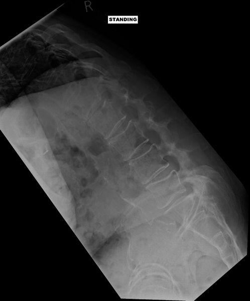 File:Camptocormia (bent spine syndrome) (Radiopaedia 46104-50456 D 1).JPG