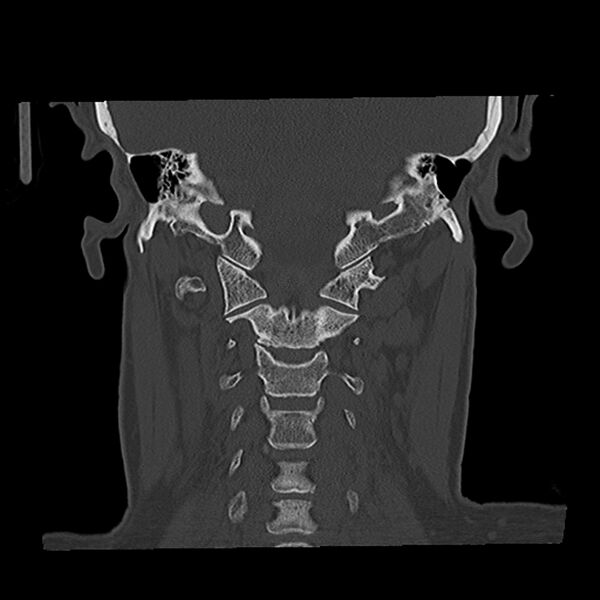 File:Canal up mastoidectomy (Radiopaedia 78108-90638 Coronal bone window 40).jpg
