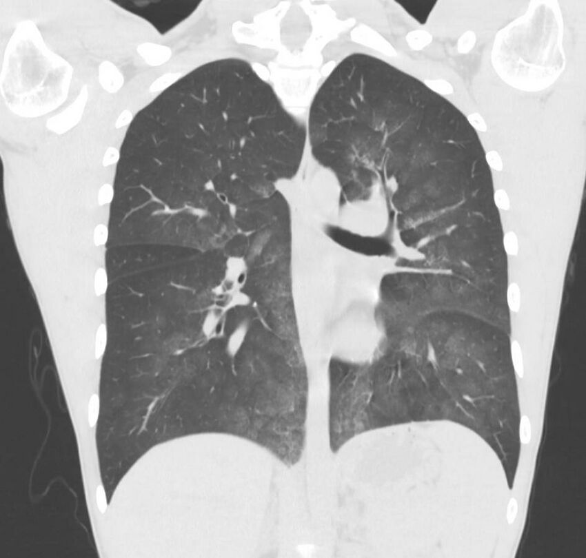 Cannabis-induced diffuse alveolar hemorrhage (Radiopaedia 89834-106946 Coronal lung window 39).jpg