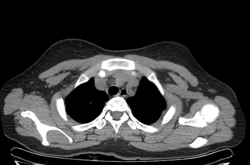 File:Cannonball metastases - uterine choriocarcinoma (Radiopaedia 70137-80173 Axial non-contrast 11).jpg