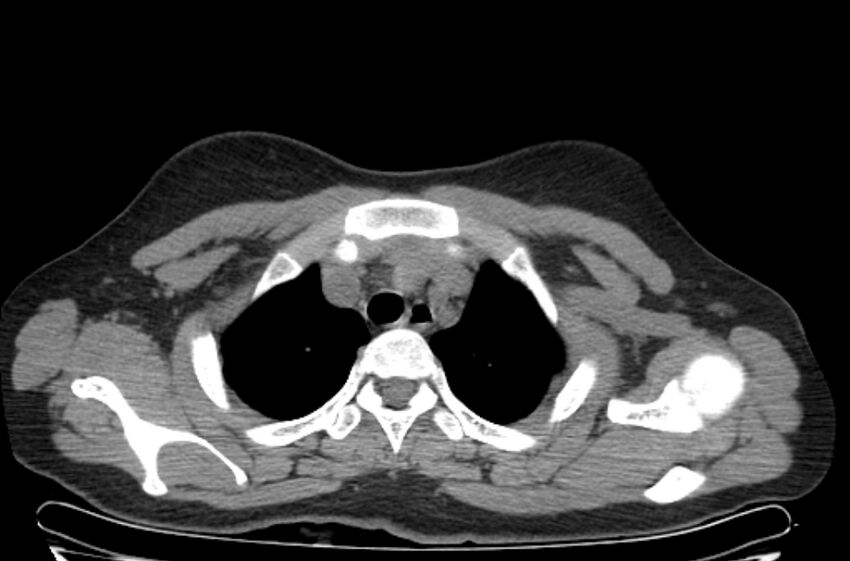 Cannonball metastases - uterine choriocarcinoma (Radiopaedia 70137-80173 Axial non-contrast 11).jpg