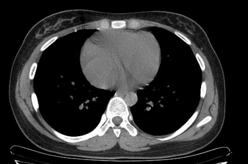 File:Cannonball metastases - uterine choriocarcinoma (Radiopaedia 70137-80173 Axial non-contrast 79).jpg