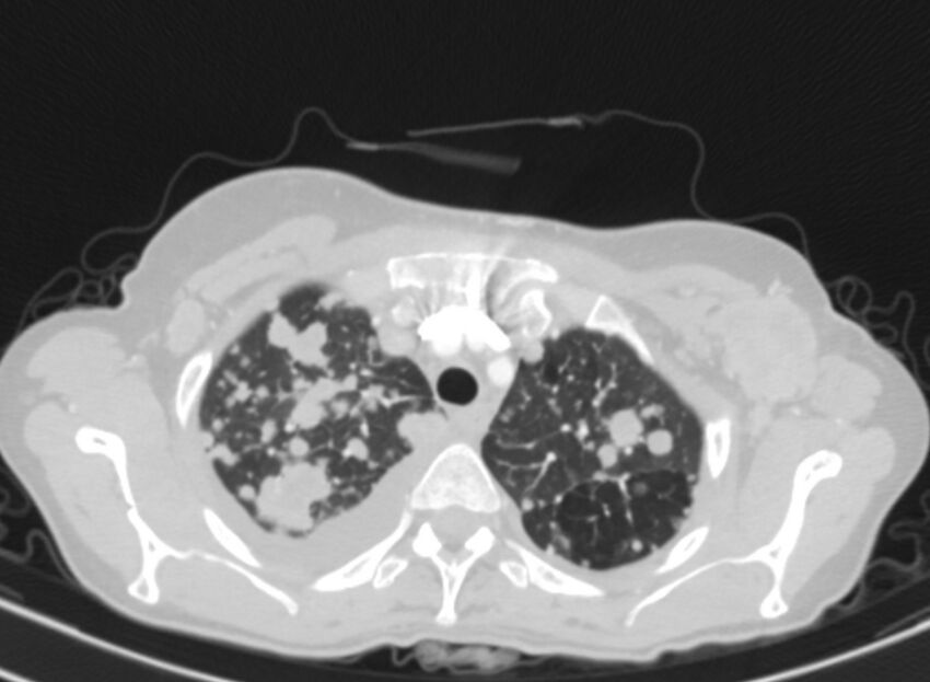 Cannonball metastases from breast cancer (Radiopaedia 91024-108569 Axial lung window 16).jpg