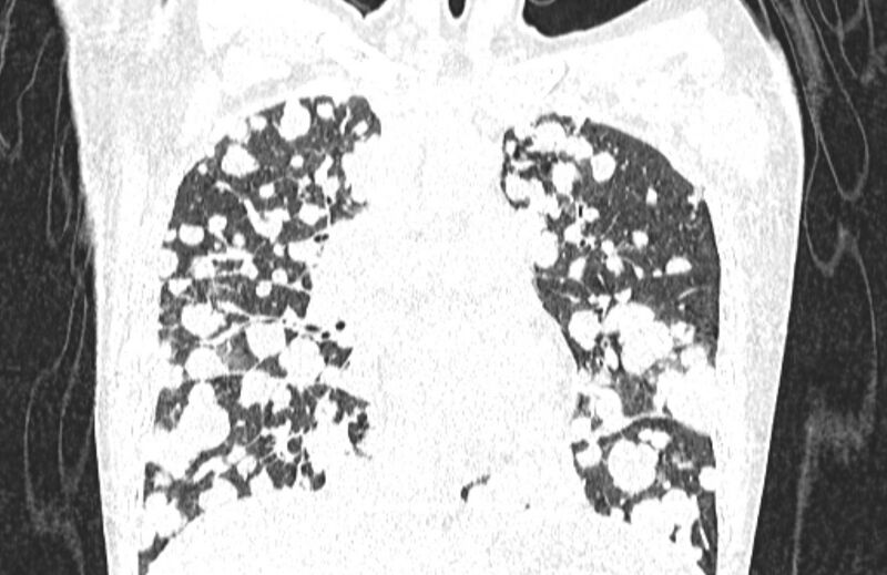 File:Cannonball metastases from breast cancer (Radiopaedia 91024-108569 Coronal lung window 65).jpg