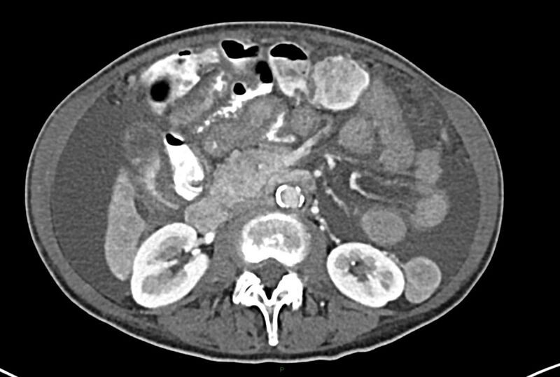 File:Carcinoid mesenteric tumor complicated by chylous ascites (Radiopaedia 76312-87953 A 33).jpg