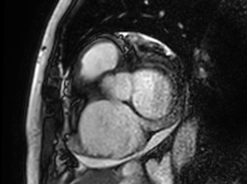 File:Cardiac amyloidosis (Radiopaedia 61600-69579 Short axis bSSFP 330).jpg