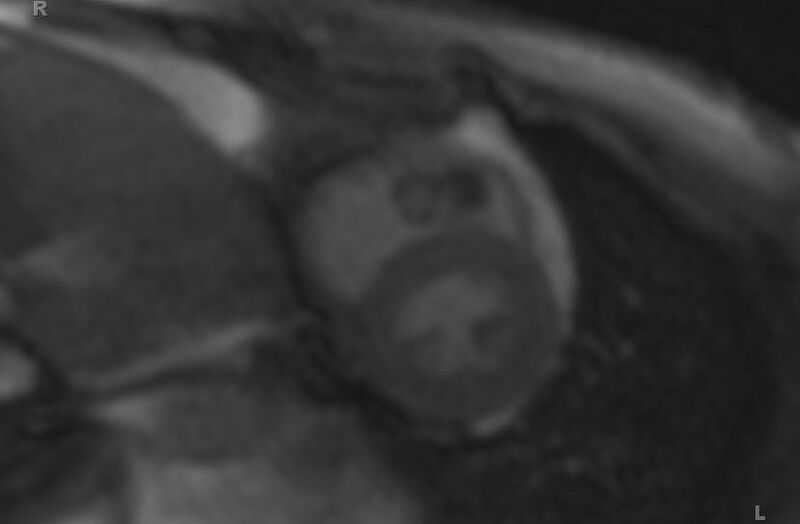 File:Cardiac hemangioma (Radiopaedia 31709-32631 Short axis 70).jpg