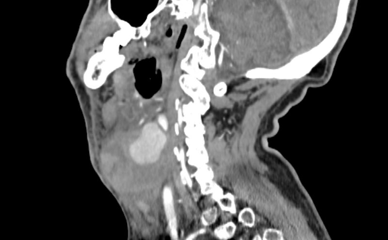 File:Carotid artery pseudoaneurysm (Radiopaedia 84030-99259 E 21).jpg