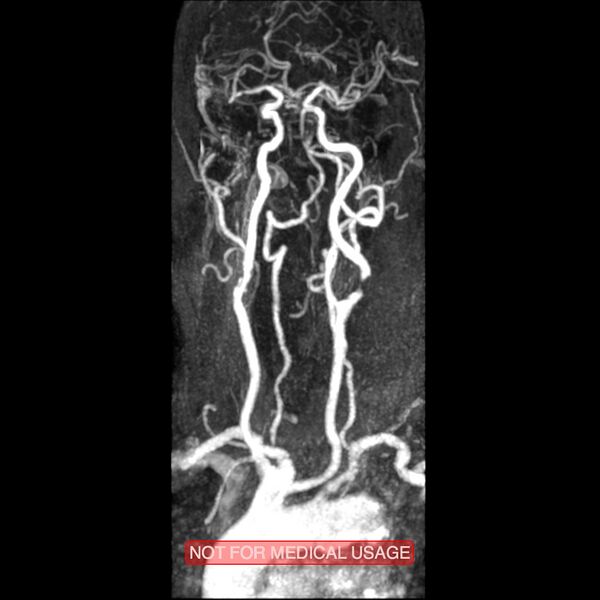 File:Carotid artery stenosis (Radiopaedia 28786-29087 3D MRA 11).jpg