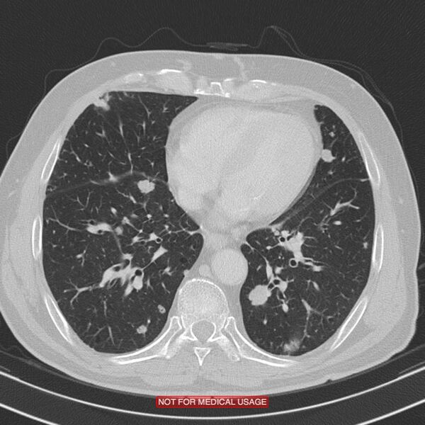 File:Cavitating pulmonary metastases (Radiopaedia 24920-25184 Axial lung window 16).jpg