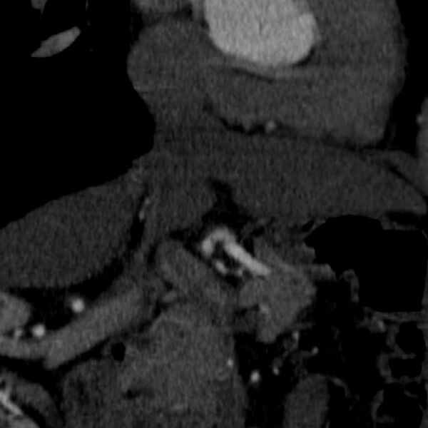 File:Celiac artery aneurysm (Radiopaedia 21574-21525 B 18).JPEG
