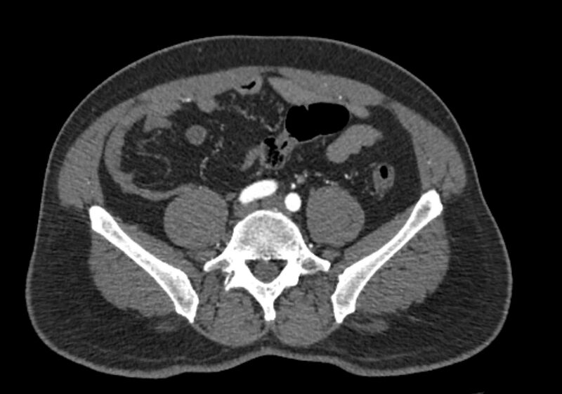 File:Celiac artery dissection (Radiopaedia 52194-58080 A 79).jpg
