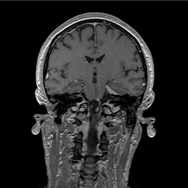 File:Central base of skull meningioma (Radiopaedia 53531-59549 Coronal T1 C+ 24).jpg