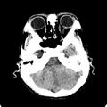 Cerebellar abscess secondary to mastoiditis (Radiopaedia 26284-26412 Axial non-contrast 32).jpg