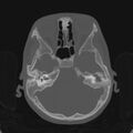 Cerebellar abscess secondary to mastoiditis (Radiopaedia 26284-26413 Axial bone window 57).jpg