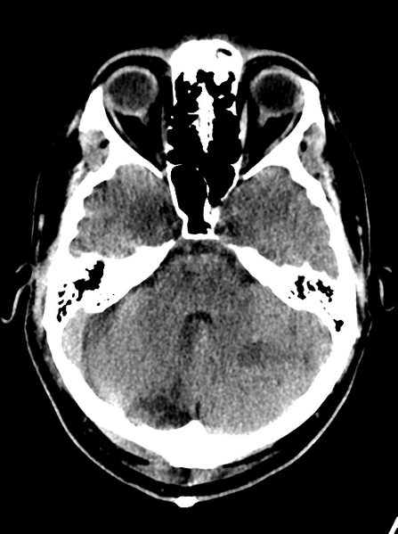 File:Cerebellar infarct due to vertebral artery dissection with posterior fossa decompression (Radiopaedia 82779-97032 Axial non-contrast 8).png