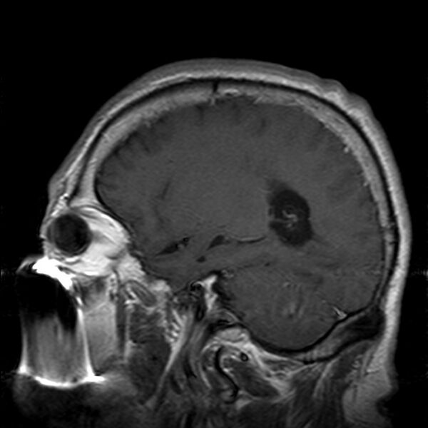 File:Cerebellopontine angle meningioma (Radiopaedia 24459-24764 Sagittal T1 C+ 18).jpg