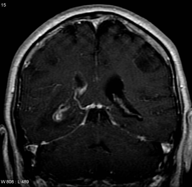 File:Cerebral abscess and ventriculitis (Radiopaedia 5024-6885 Coronal T1 C+ 7).jpg