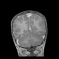 Cerebral abscess post cardiac surgery (Radiopaedia 27244-27420 Coronal T1 C+ 17).jpg
