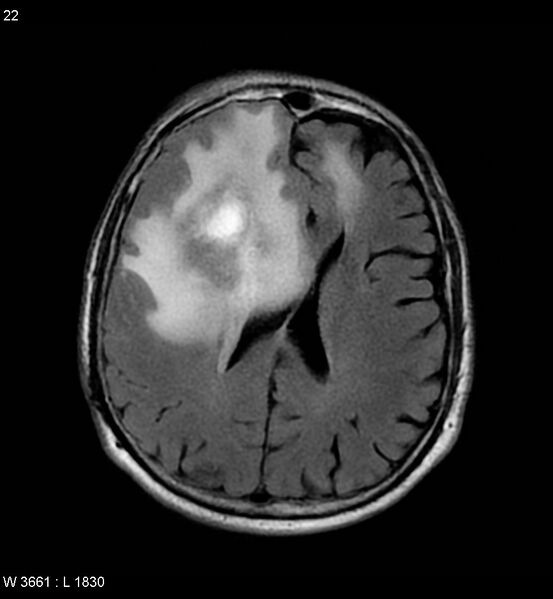 File:Cerebral abscesses secondary to contusions (Radiopaedia 5201-6968 Axial FLAIR 1).jpg