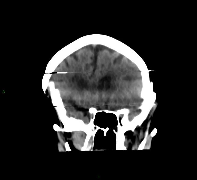 File:Cerebral amyloid angiopathy-associated lobar intracerebral hemorrhage (Radiopaedia 58377-65514 Coronal non-contrast 45).jpg