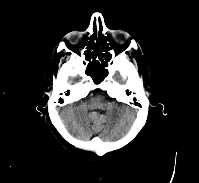 File:Cerebral amyloid angiopathy-associated lobar intracerebral hemorrhage (Radiopaedia 58529-65681 Axial non-contrast 41).jpg