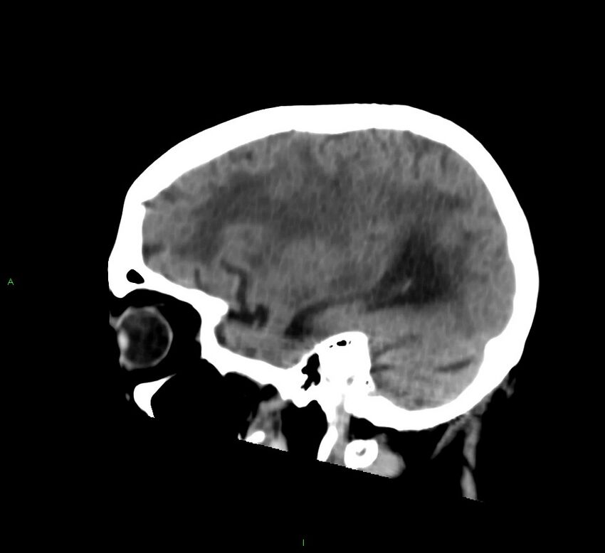 Cerebral amyloid angiopathy-associated lobar intracerebral hemorrhage (Radiopaedia 58530-65688 C 16).jpg