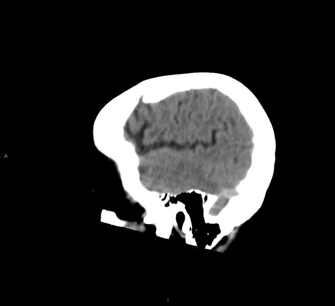File:Cerebral amyloid angiopathy-associated lobar intracerebral hemorrhage (Radiopaedia 58530-65688 C 46).jpg