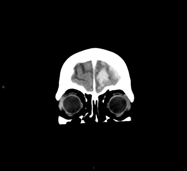 File:Cerebral amyloid angiopathy-associated lobar intracerebral hemorrhage (Radiopaedia 58561-65724 Coronal non-contrast 54).jpg