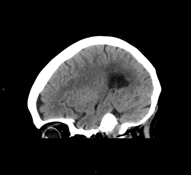 File:Cerebral amyloid angiopathy-associated lobar intracerebral hemorrhage (Radiopaedia 58563-65727 C 37).jpg
