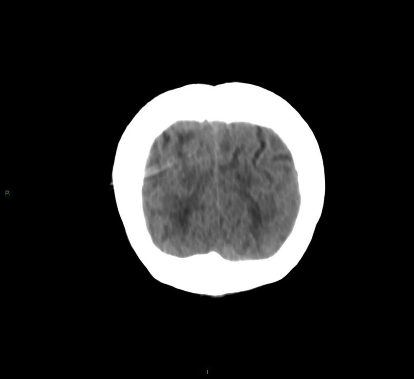 Cerebral amyloid angiopathy-associated lobar intracerebral hemorrhage (Radiopaedia 58566-65730 Coronal non-contrast 12).jpg